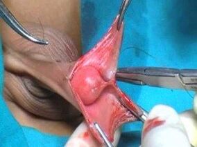 مردانہ عضو تناسل کو بڑھانے کی سرجری